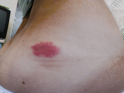 黄蜂后卫意外发现左腿有伤痕，球队医疗组已介入的简单介绍